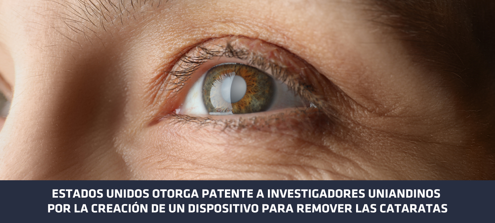 Patente Uniandina – Dispositivo para cirugía de cataratas